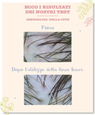 Test sensibilità della cute: prima e dopo l'utilizzo della lozione