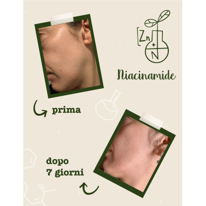 Foto prima e dopo utilizzo del siero Niacinamide e Zinco - trattamento 7 giorni