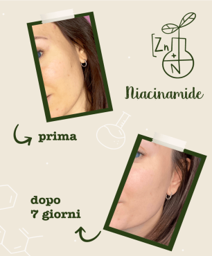 Foto prima e dopo utilizzo del siero Niacinamide e Zinco - trattamento 7 giorni