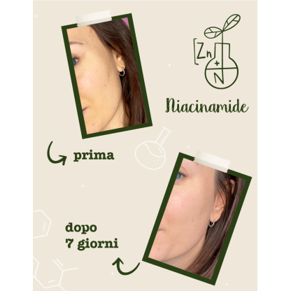 Foto prima e dopo utilizzo del siero Niacinamide e Zinco - trattamento 7 giorni