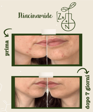 Foto prima e dopo utilizzo del siero Niacinamide e Zinco - trattamento 7 giorni