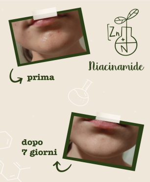 Foto prima e dopo utilizzo del siero Niacinamide e Zinco - trattamento 7 giorni
