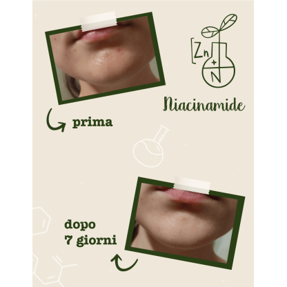 Foto prima e dopo utilizzo del siero Niacinamide e Zinco - trattamento 7 giorni
