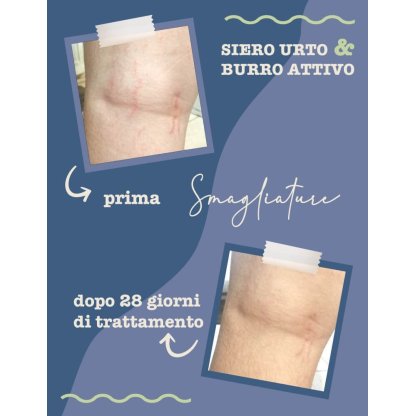 Foto Prima e Dopo l'utilizzo del siero smagliature dopo 28 giorni