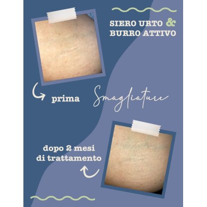Foto Prima e Dopo l'utilizzo del siero smagliature dopo 2 mesi