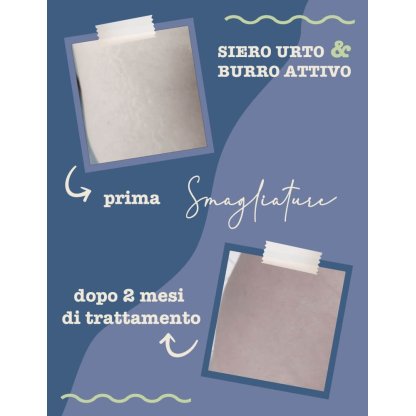 Foto Prima e Dopo trattamento antismagliature dopo 2 mesi