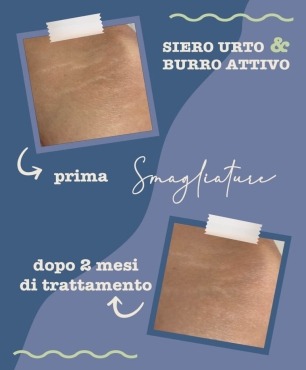 Foto Prima e Dopo trattamento antismagliature dopo 2 mesi