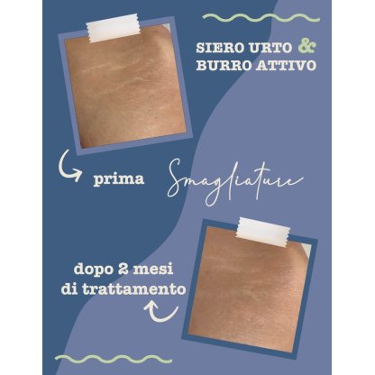 Foto Prima e Dopo trattamento antismagliature dopo 2 mesi