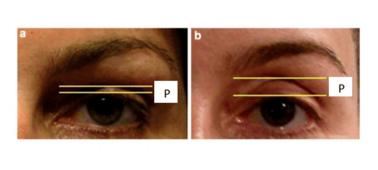 PALPEBRA LIFTATA CONTORNO OCCHI WOW