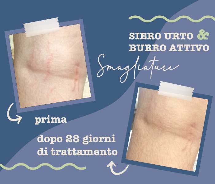 SMAGLIATURE PRIMA DOPO